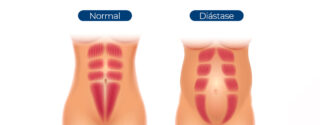 Diástase abdominal: o que é e como tratar?